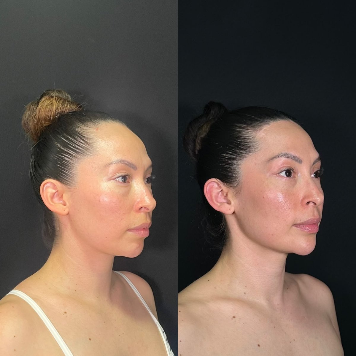 Résultats avant/après remodelage du front au Zafir Medical Center, profil facial amélioré