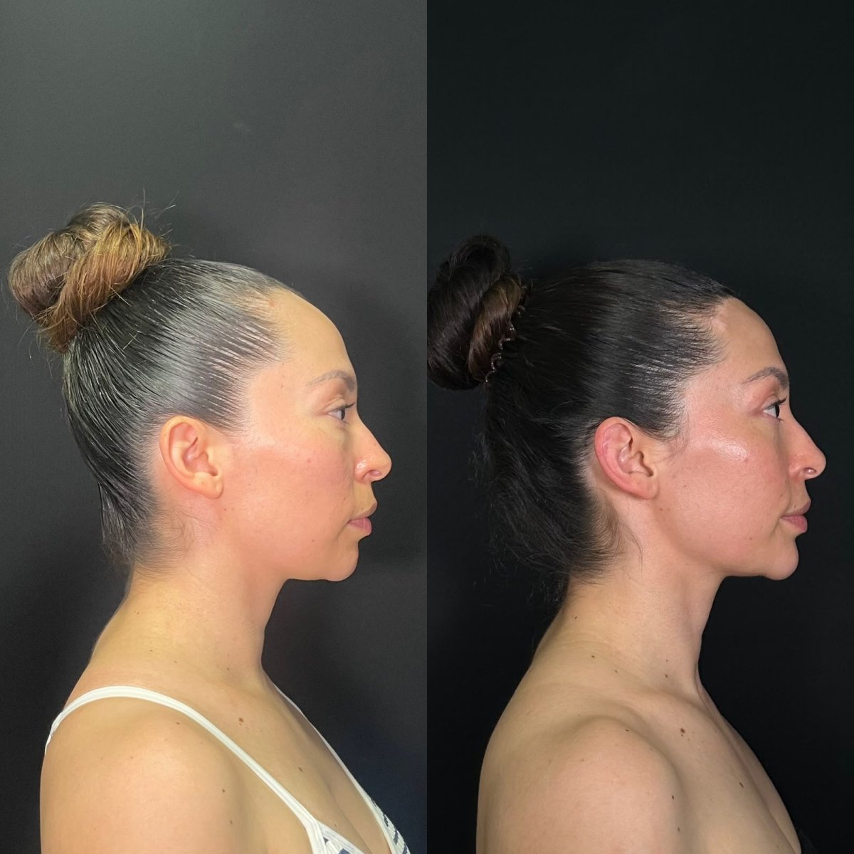 Before and after forehead contouring results at Zafir Medical Center, improved facial profile