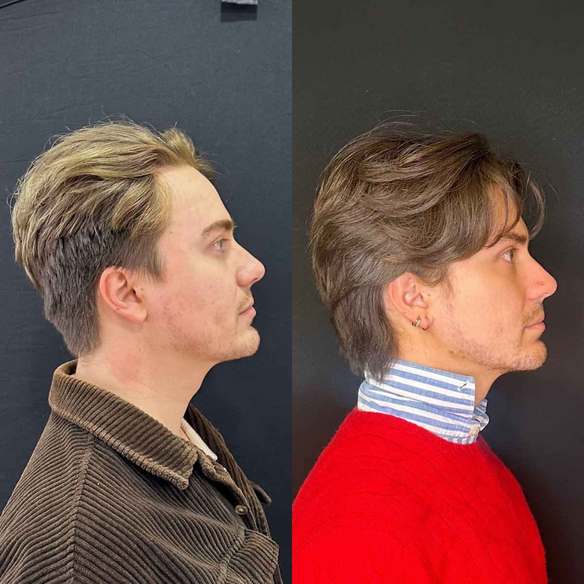 Forehead contouring before and after results at Zafir Medical Center, improved facial profile