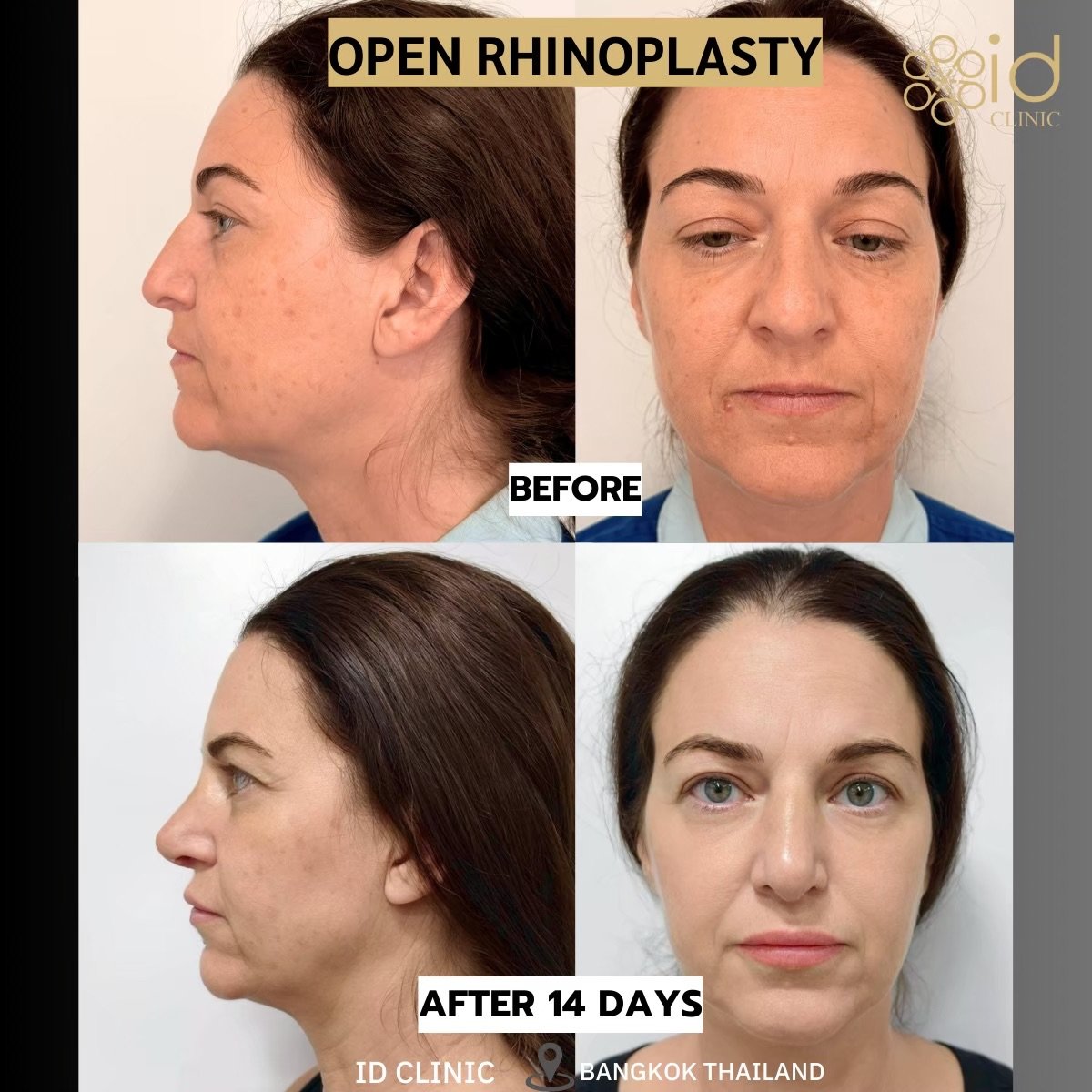 Efekty otwartej plastyki nosa przed i po w ID Clinic Bangkok, widoczna zmiana po 14 dniach