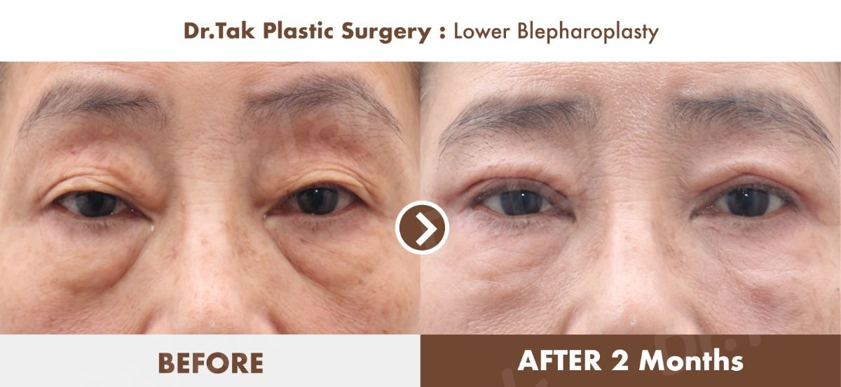 Resultados de blefaroplastia inferior antes y después en Dr. Tak Plastic Surgery, menos bolsas