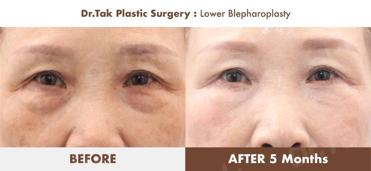Lower blepharoplasty before and after results at Dr. Tak Plastic Surgery, reduced eye bags
