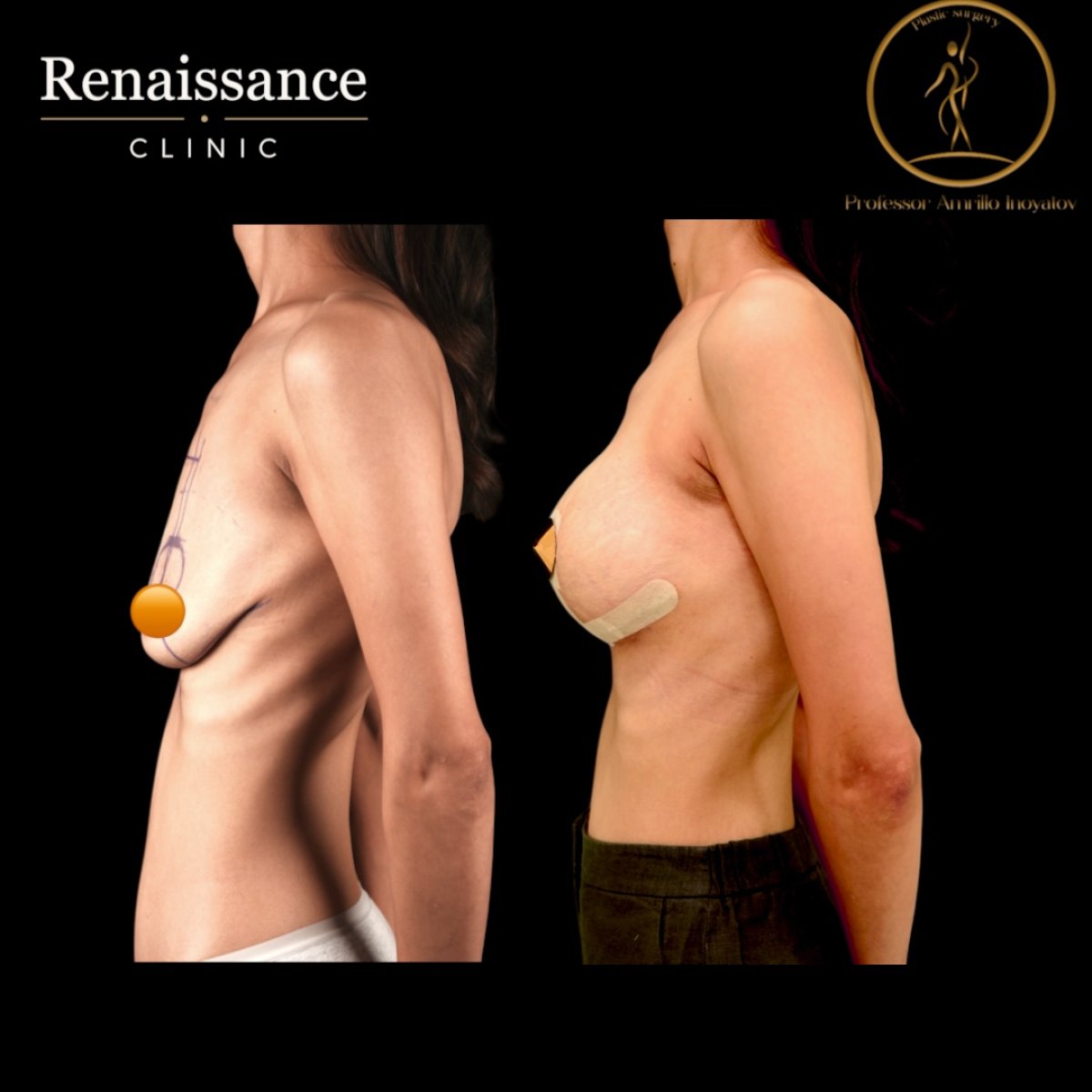 Before and after mammoplasty results at Renaissance Clinic – visible breast augmentation outcome