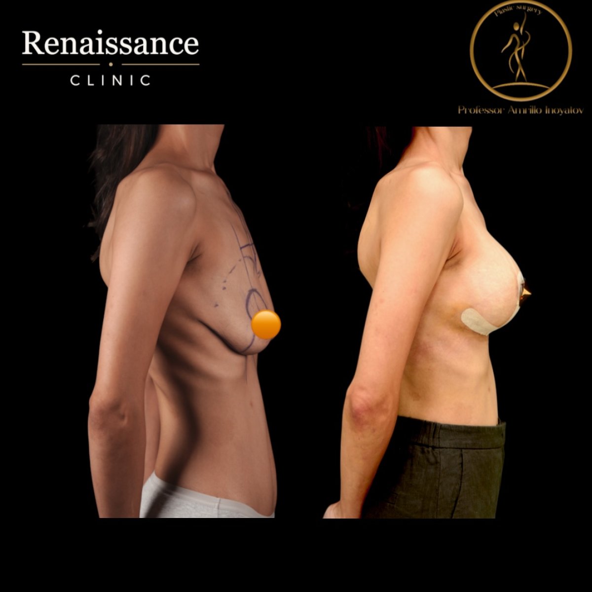 Before and after mammoplasty results at Renaissance Clinic – visible breast augmentation outcome