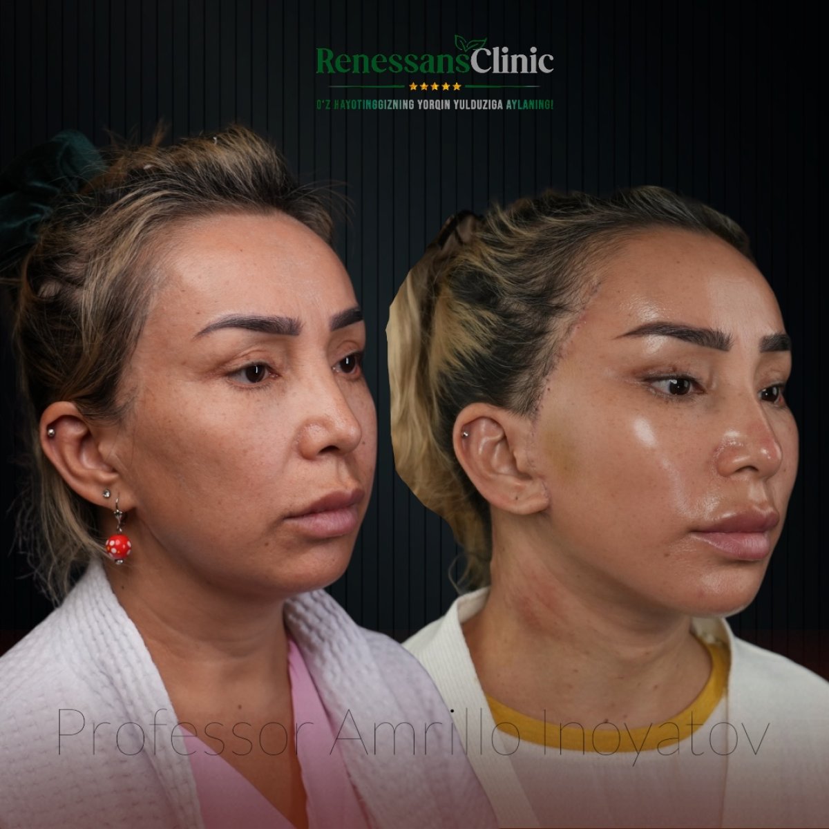 Facelift before and after results at Renaissance Clinic, visible facial contour improvement