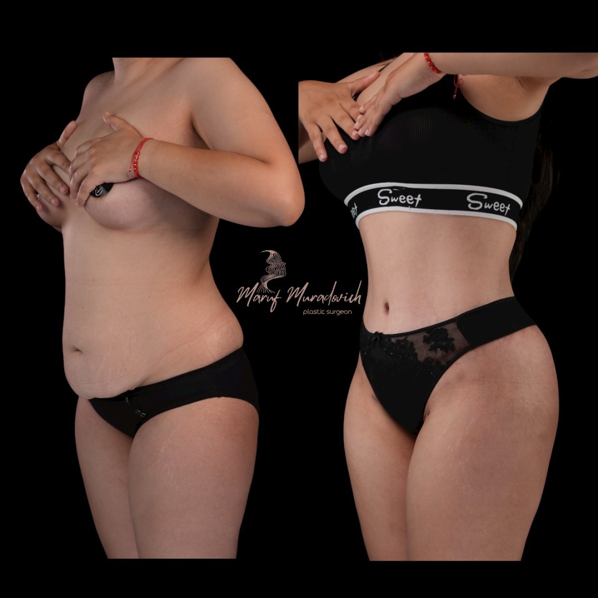 Résultats avant/après liposuccion à Renaissance Clinic – silhouette affinée taille et ventre