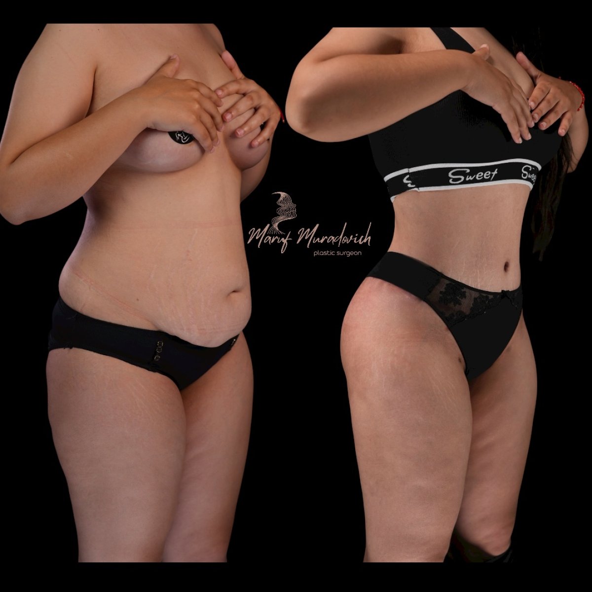 Résultats avant/après liposuccion à Renaissance Clinic – silhouette affinée taille et abdomen