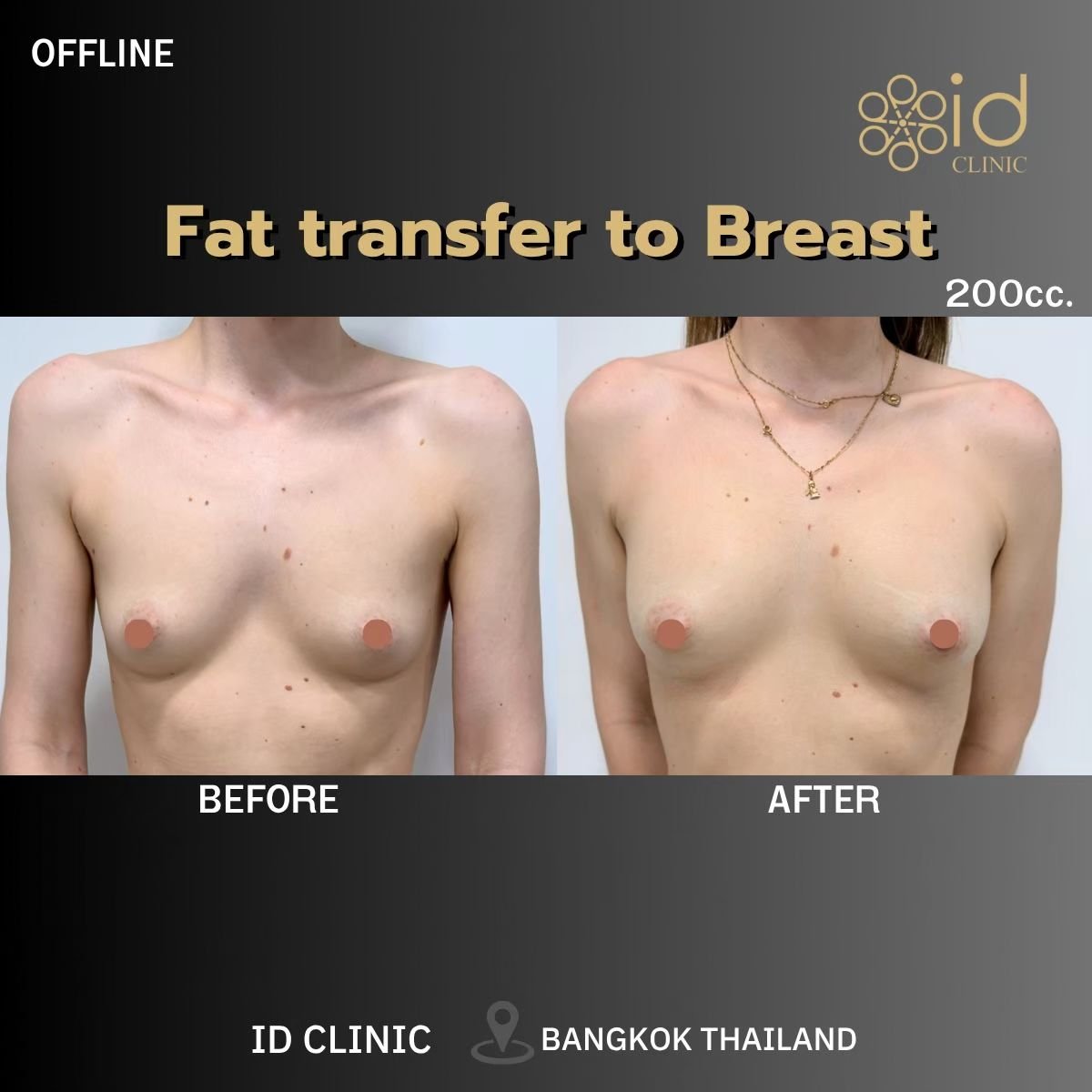 نتائج تكبير الثدي بحقن الدهون قبل وبعد في ID Clinic Bangkok