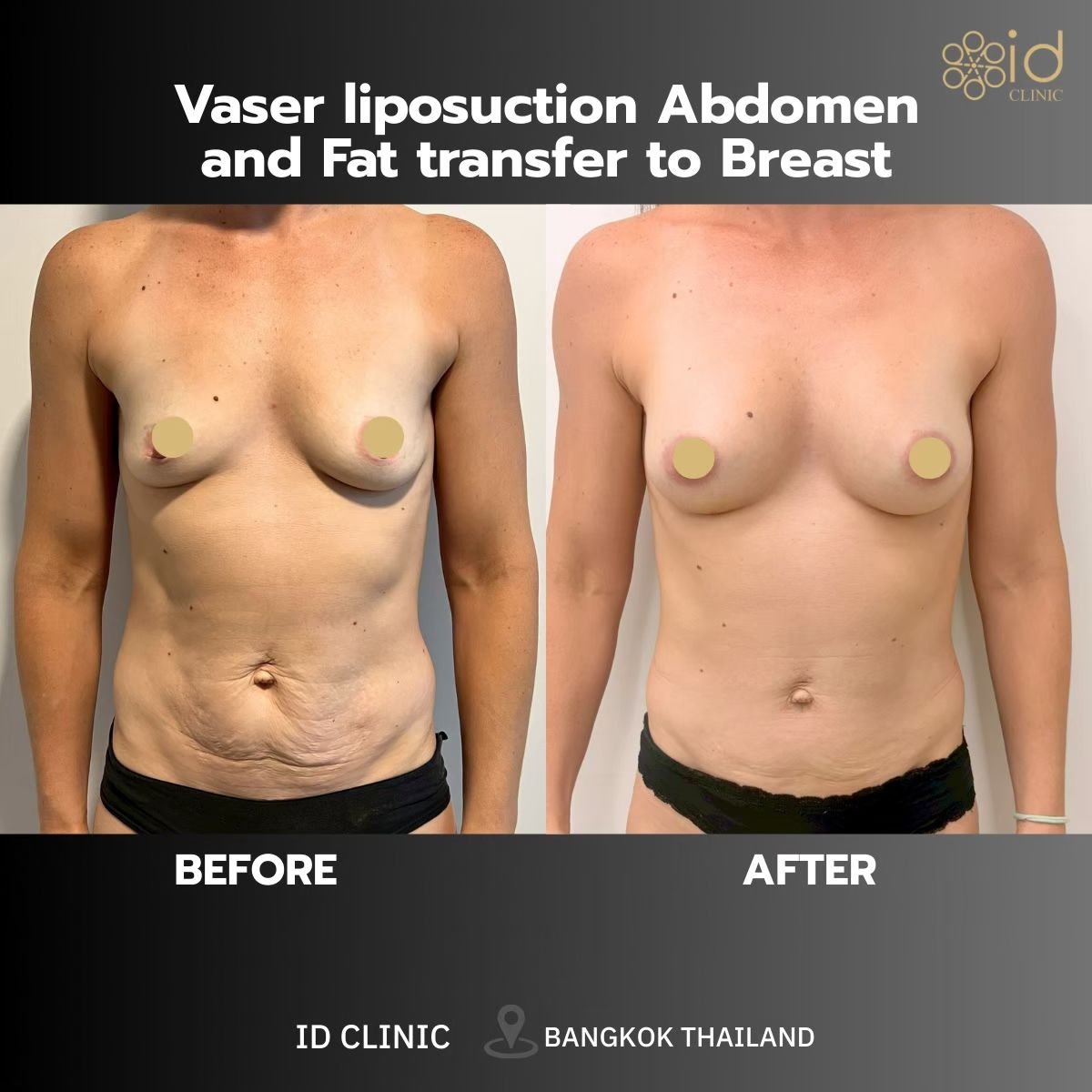 До и после увеличения груди липофилингом в ID Clinic Bangkok, видимый результат