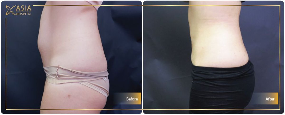 Before and after liposuction results at Asia Cosmetic Hospital, visible abdominal contouring