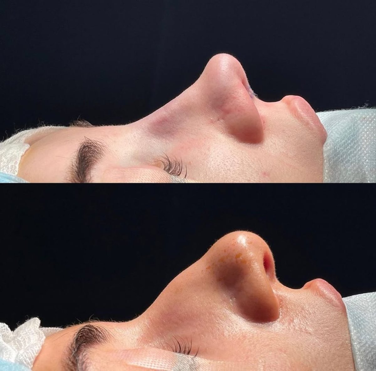 Vorher-nachher-Ergebnis der Nasenkorrektur in der Renaissance Clinic, verbesserte Nasenkontur
