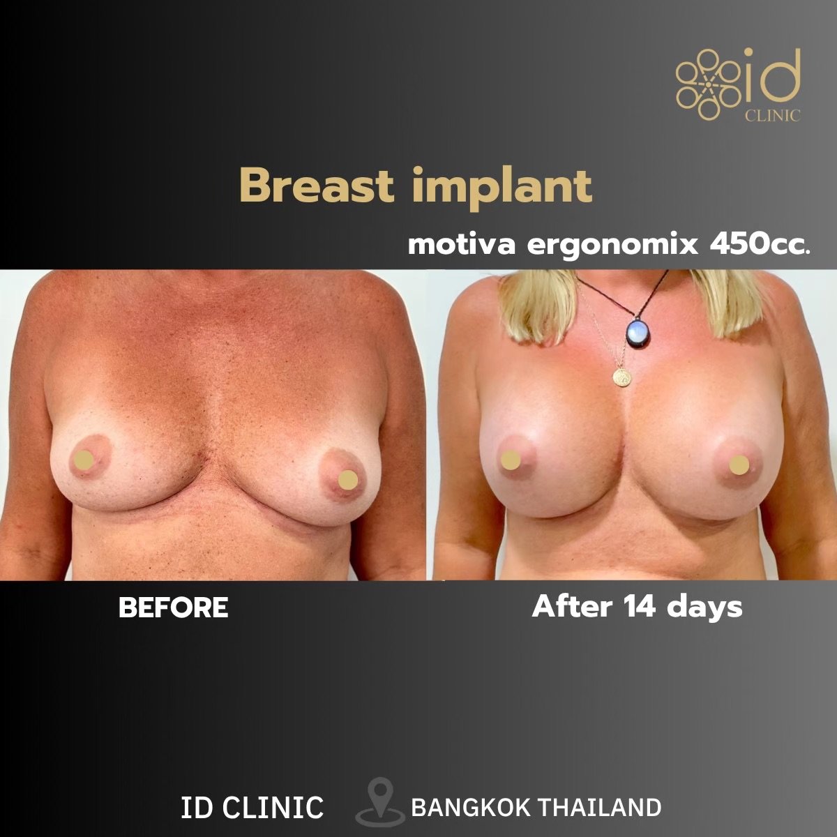 نتائج تصحيح زراعة الثدي Motiva Ergonomix 450cc في ID Clinic Bangkok