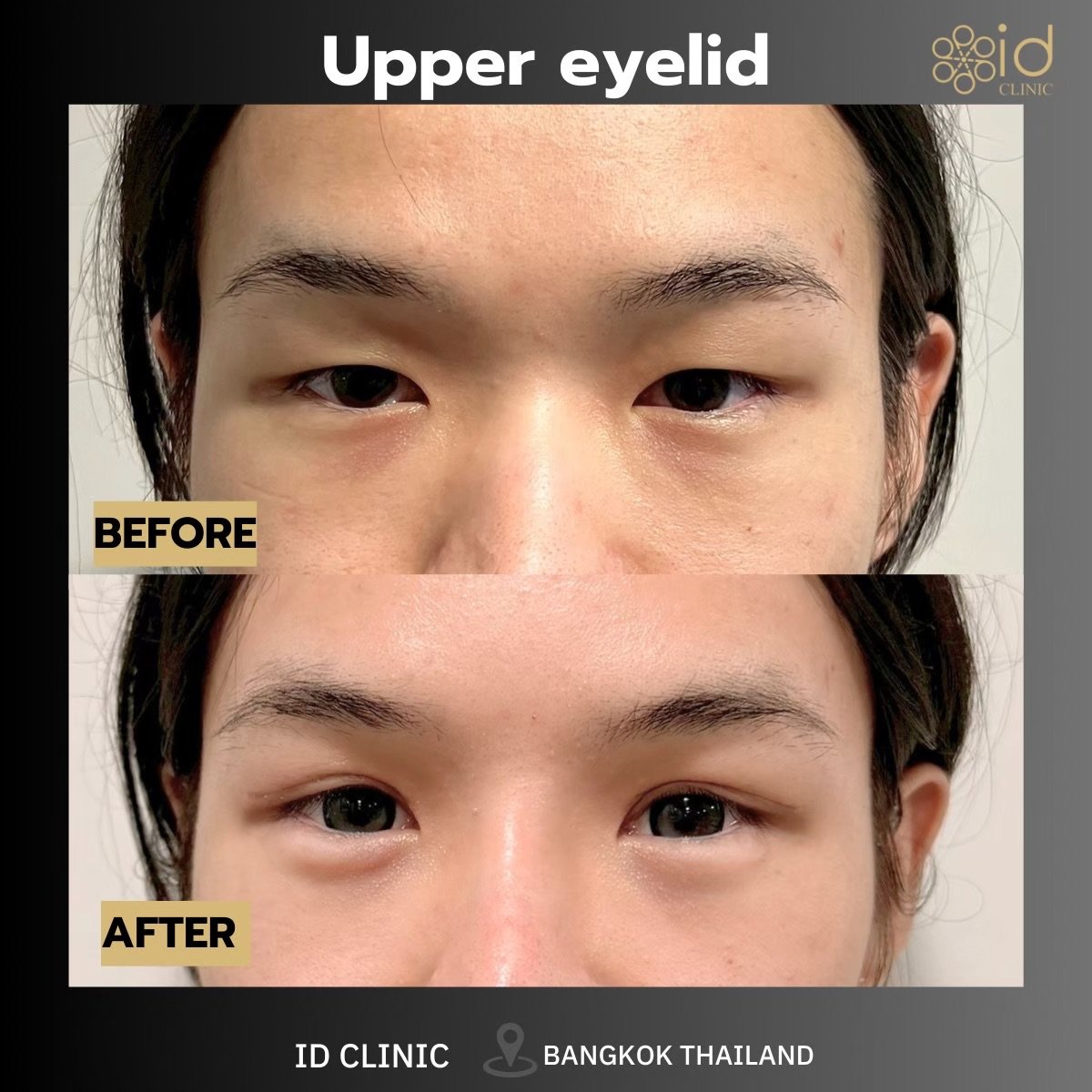 Before and after upper eyelid surgery results at ID Clinic Bangkok, improved eyelid contour