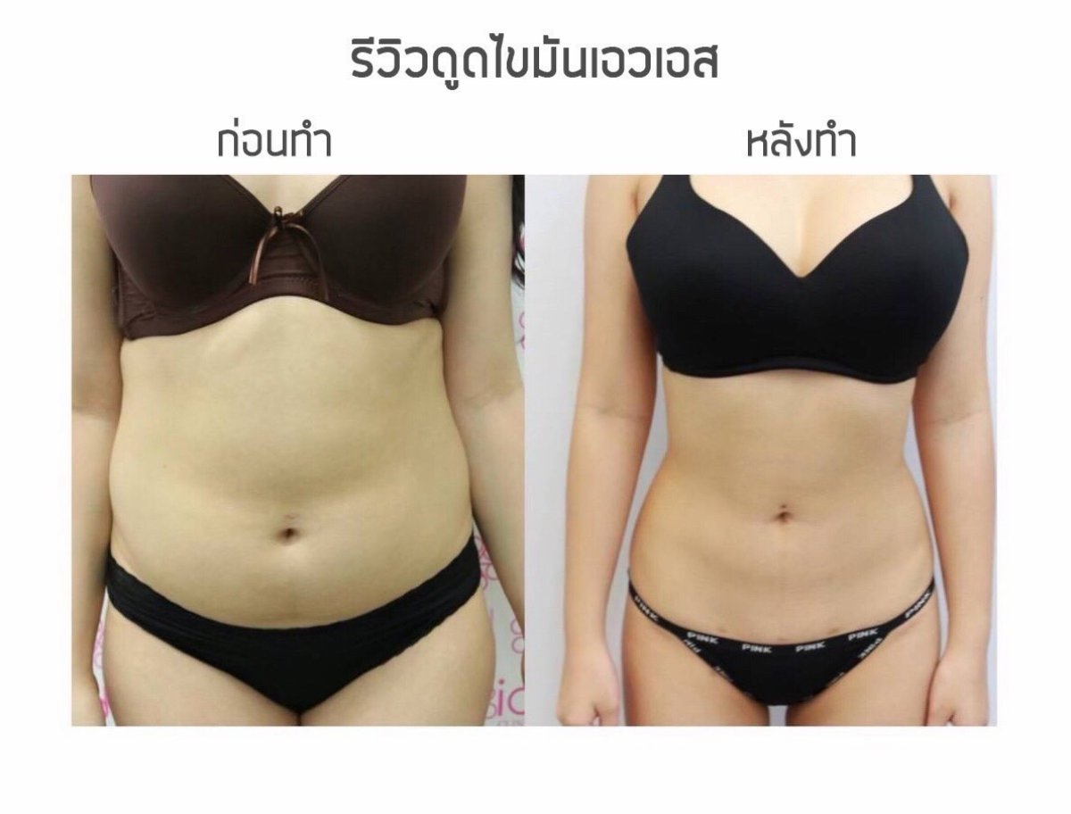 نتائج شفط الدهون قبل وبعد في عيادة Somchai – خصر وبطن أنحف