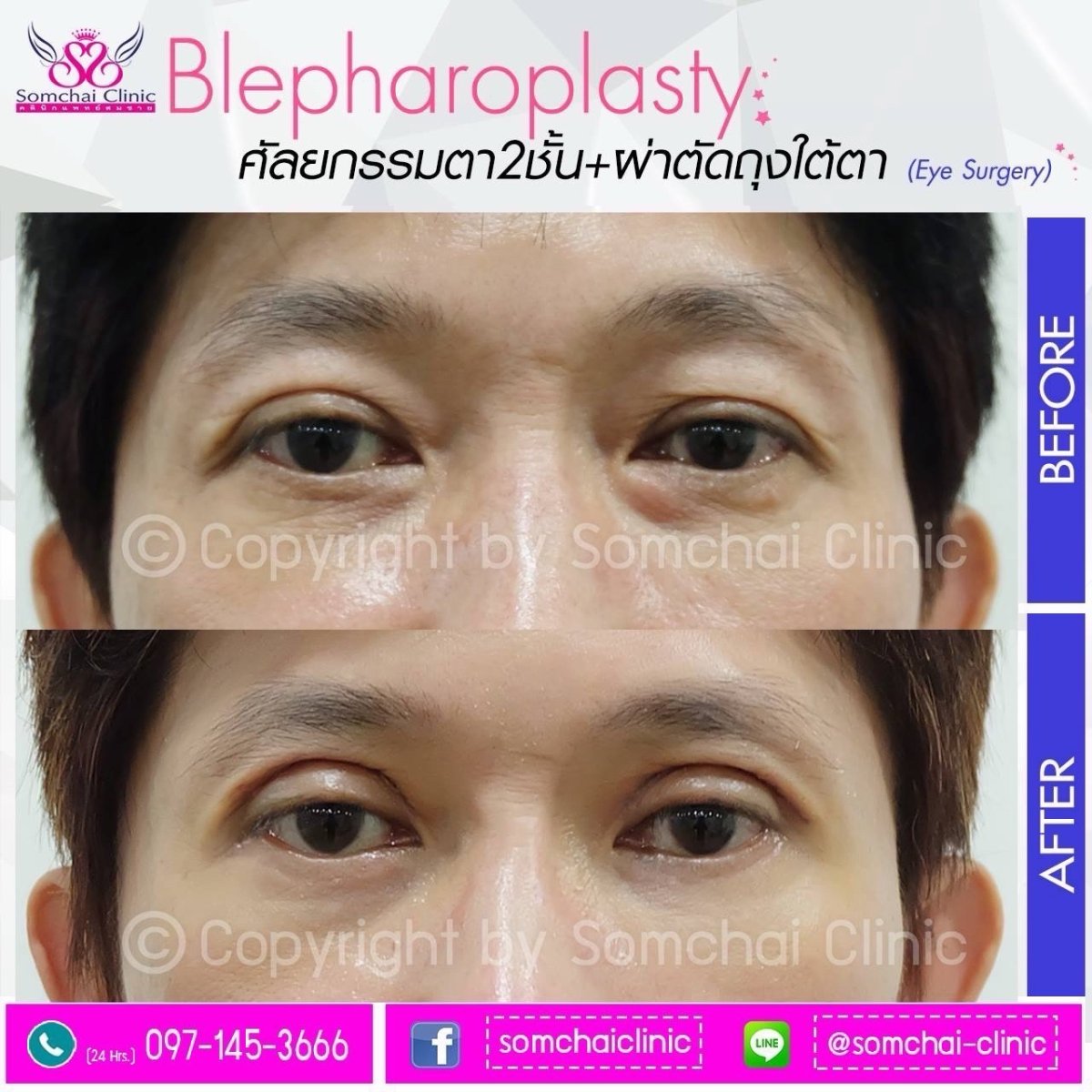 Resultados antes y después de cirugía de párpado superior en Somchai Clinic, mejora ocular