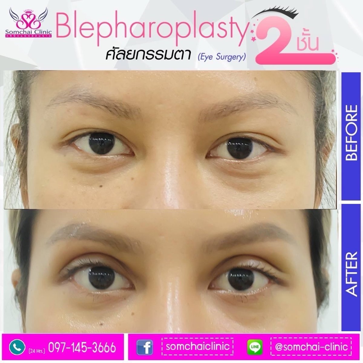 Resultados de cirugía de párpado superior antes y después en Somchai Clinic, mejora visible