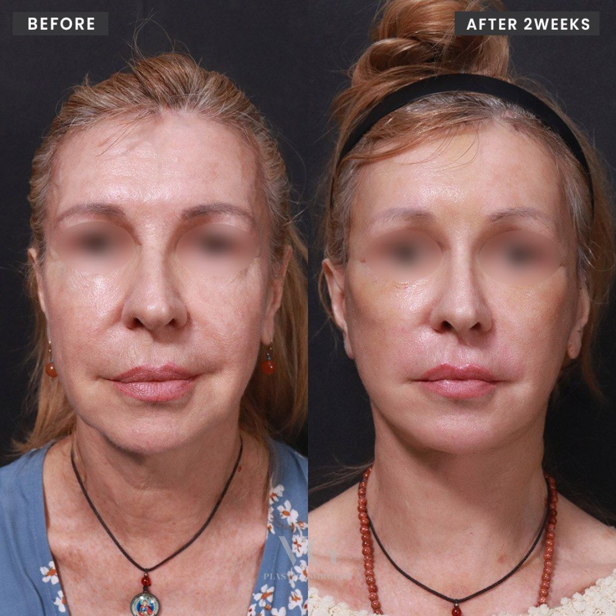 Before and after endoscopic facelift results at VG Plastic Surgery, visible facial rejuvenation
