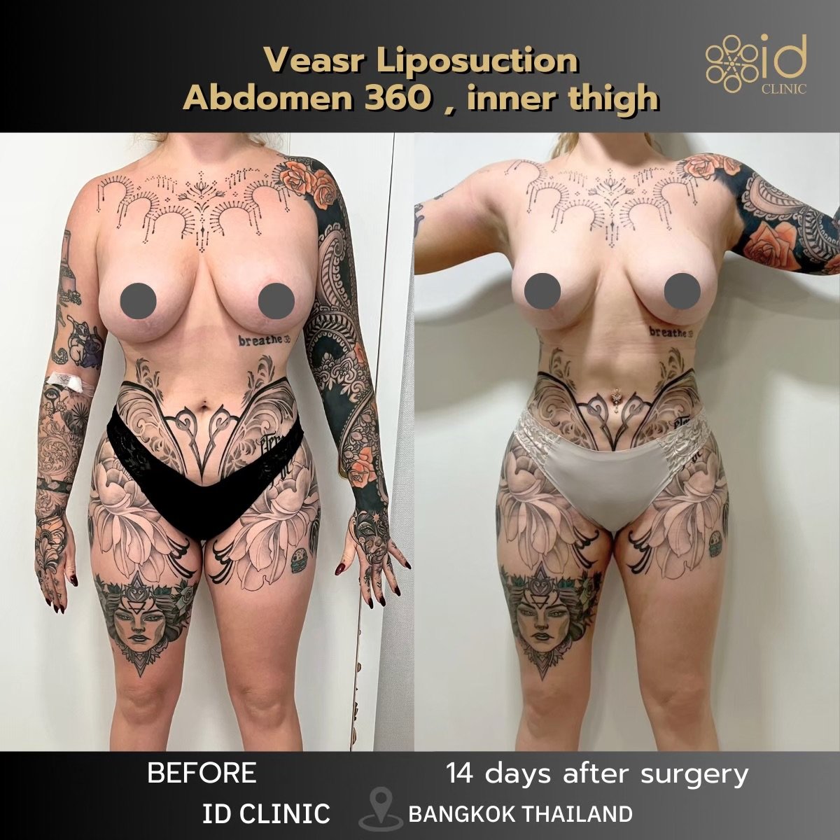 Resultados de liposucción abdominal 360 y muslo interno antes y después en ID Clinic Bangkok