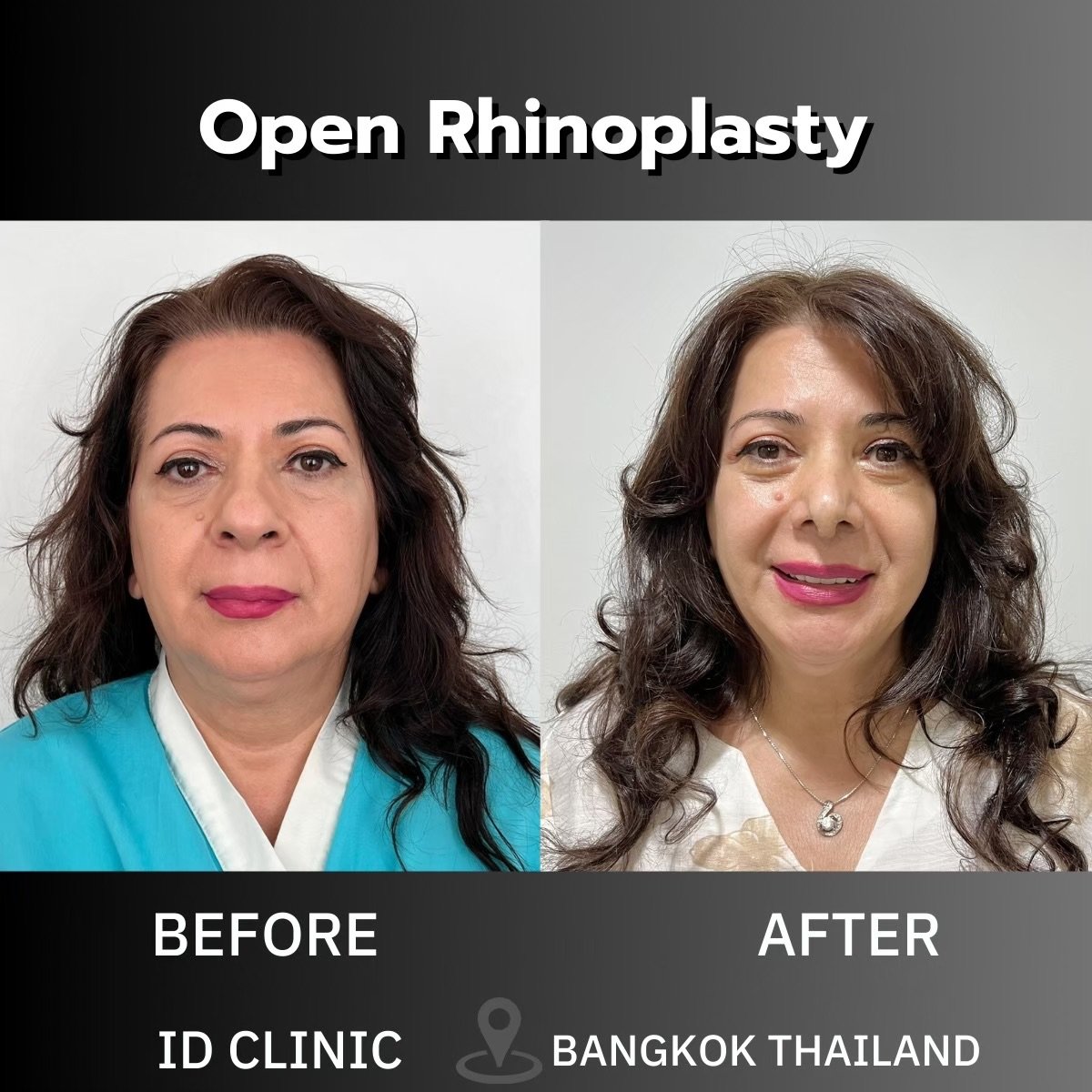 Before and after open rhinoplasty results at ID Clinic Bangkok, nose reshaping improvement