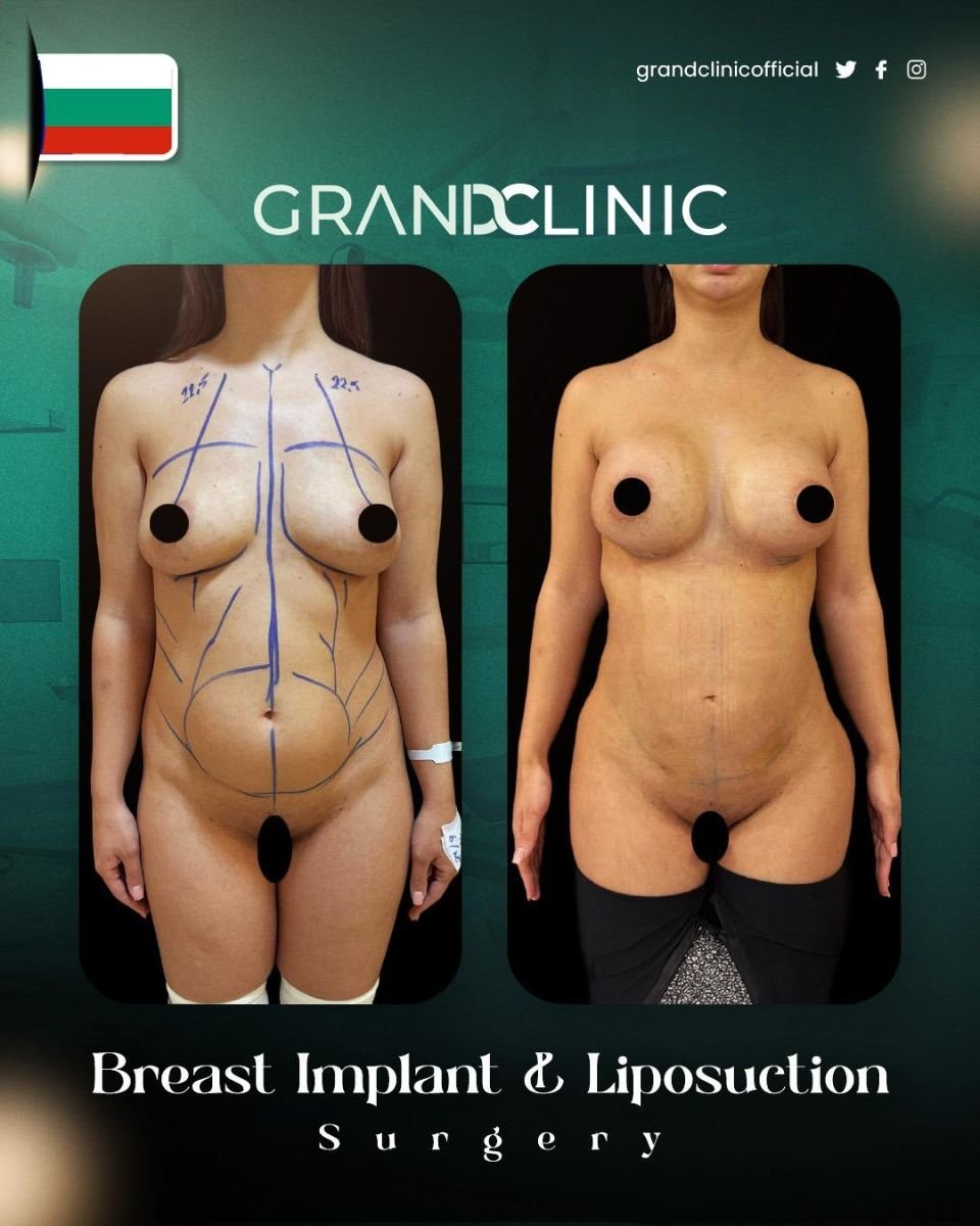 Résultats avant/après implants mammaires et Vaser liposuccion à Grand Clinic