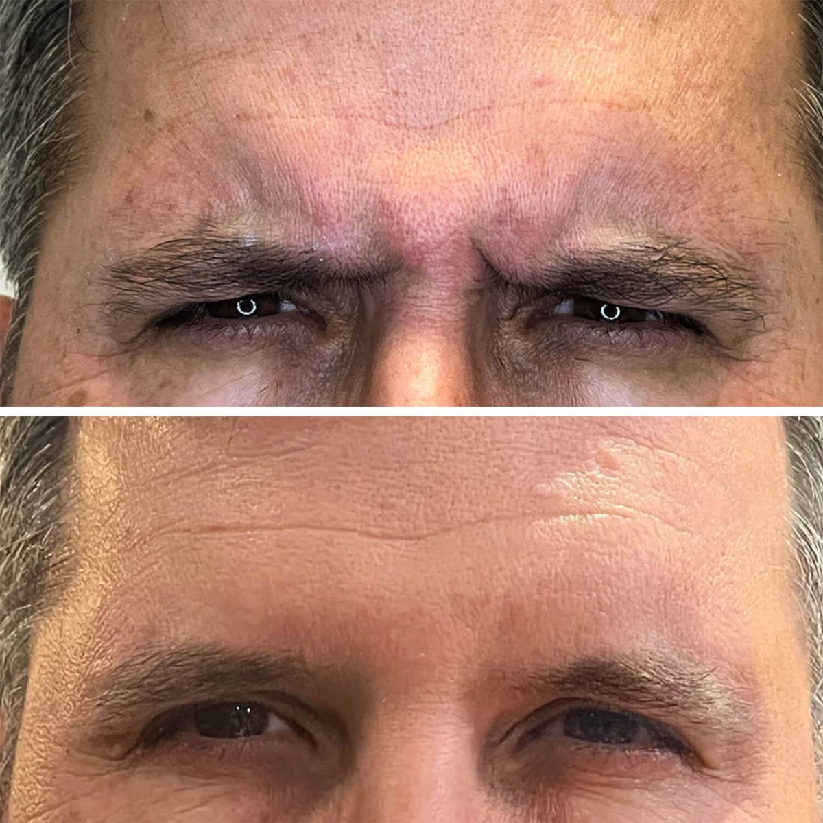 Vorher-nachher-Ergebnis: Botox gegen Stirnfalten, sichtbare Glättung in der Klinik