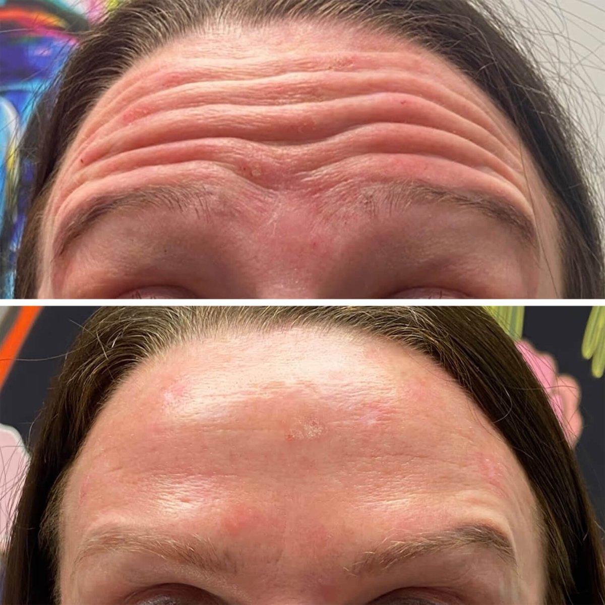 Vorher-nachher-Ergebnis Botox-Stirn – glattere Haut und sichtbare Verjüngung