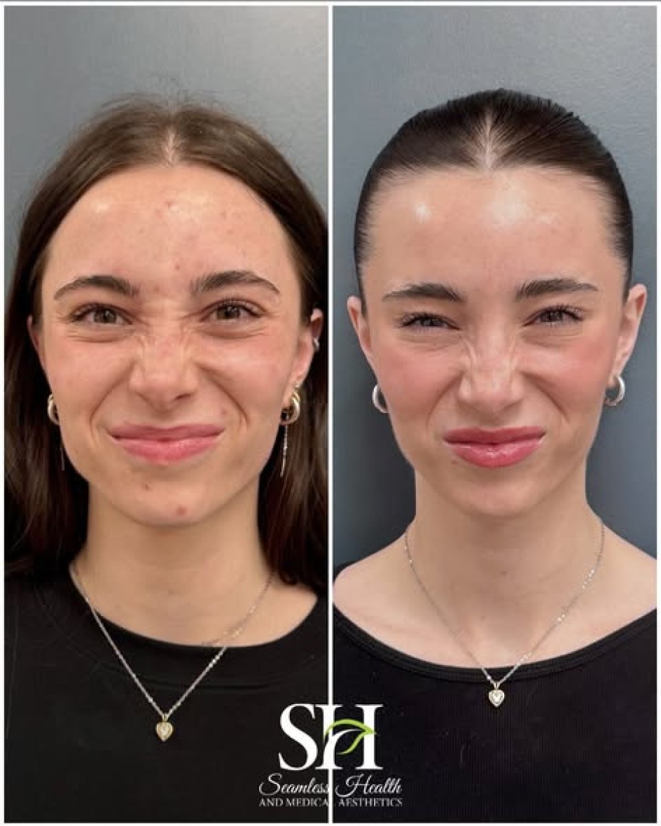 Antes y después de botox para arrugas en Seamless Health, frente más lisa