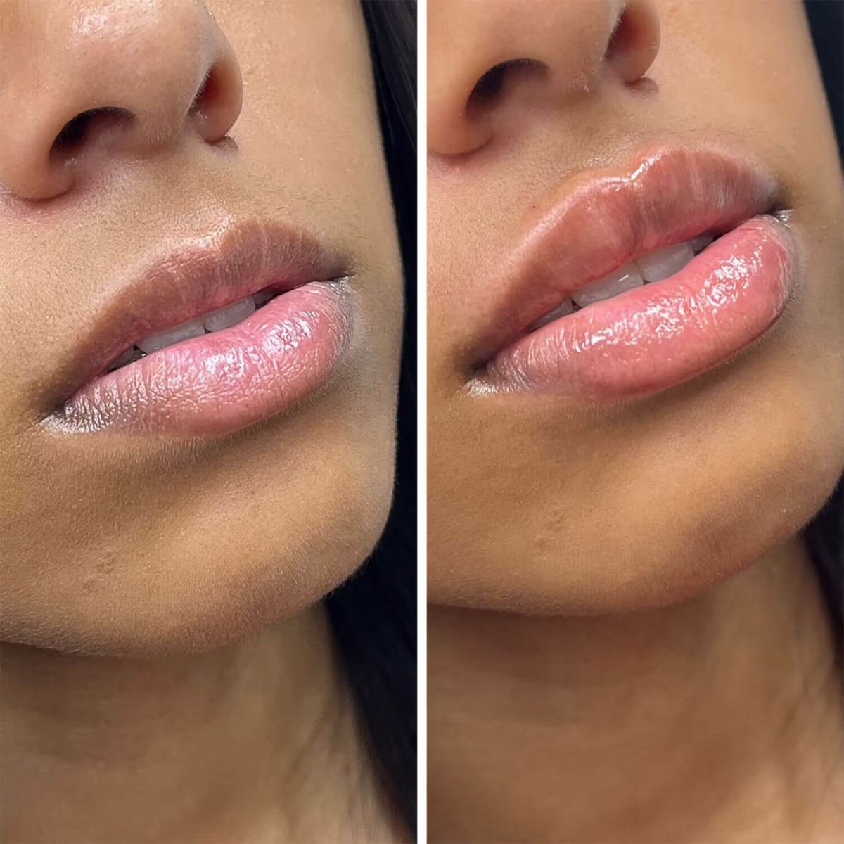 Resultados antes y después de relleno de labios: mayor volumen y mejora del contorno