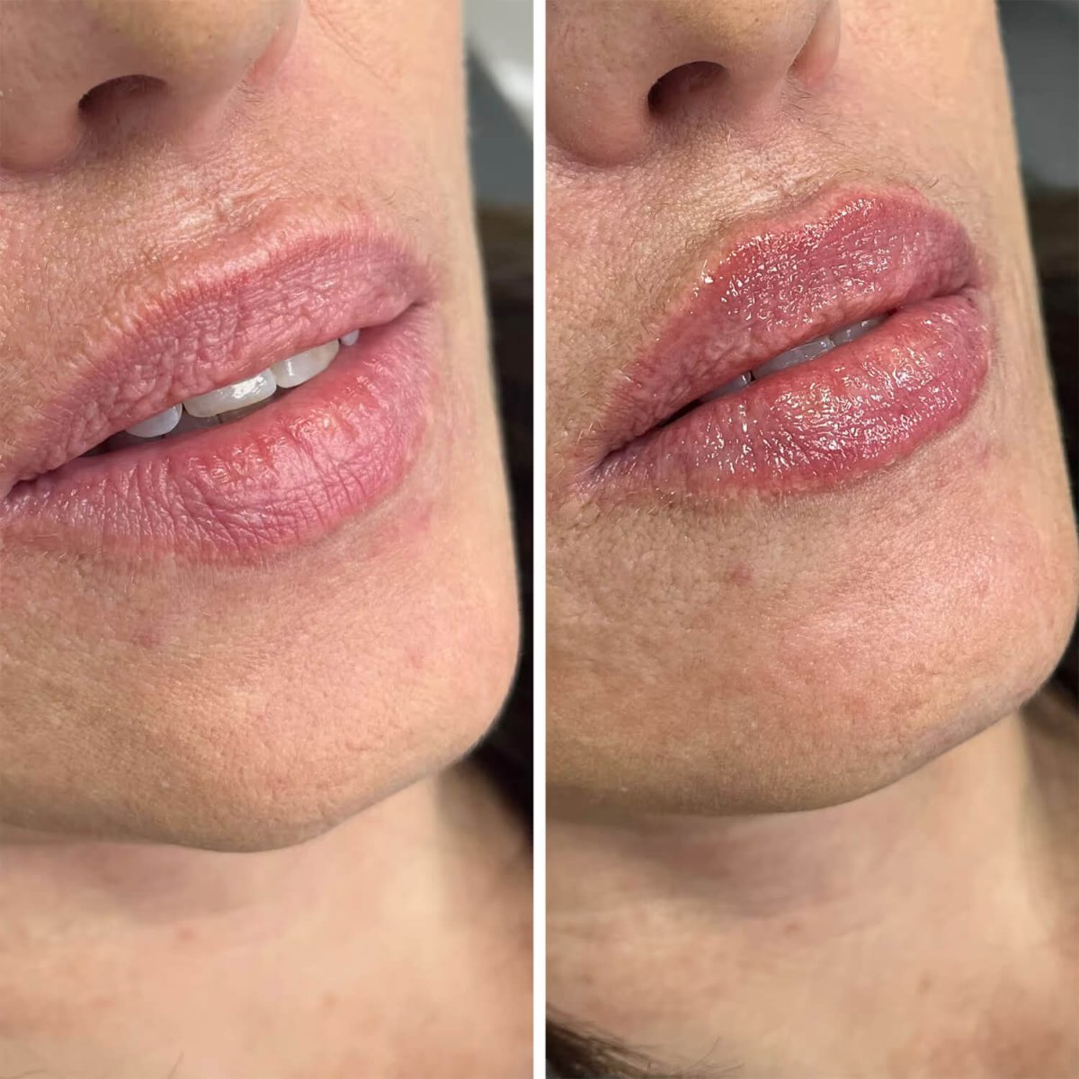Vorher-nachher-Ergebnis Lippenfiller – mehr Volumen und verbesserte Kontur