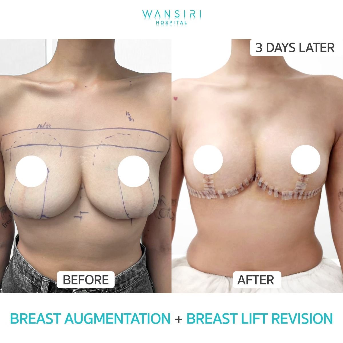 Before and after breast augmentation with lift revision results at Wansiri Hospital