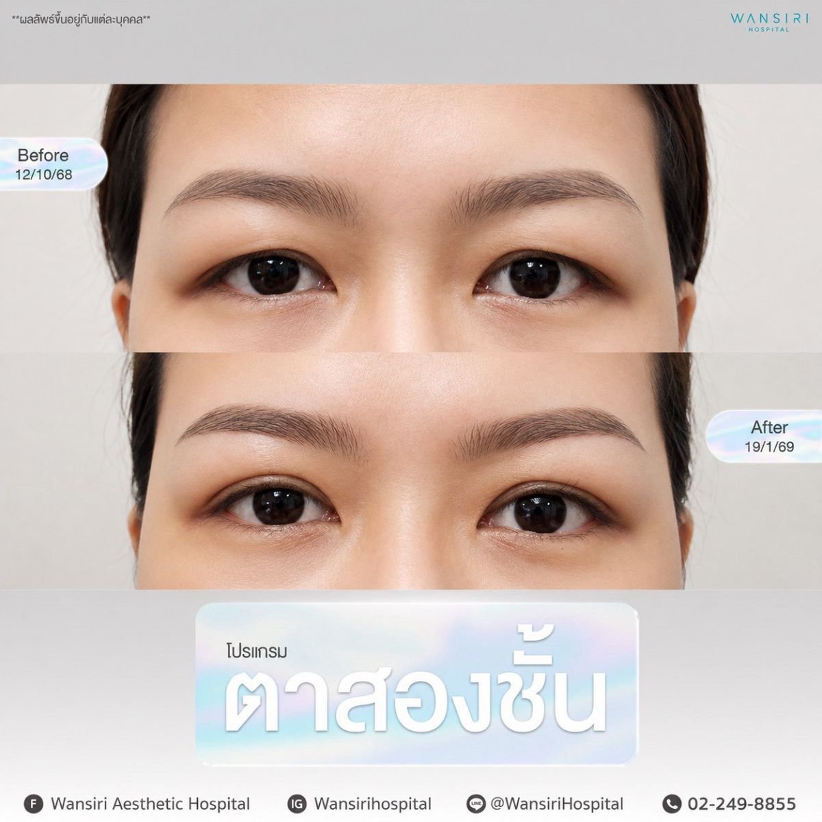 Vorher-nachher-Ergebnisse der Blepharoplastik in Wansiri Hospital, Lidkorrektur