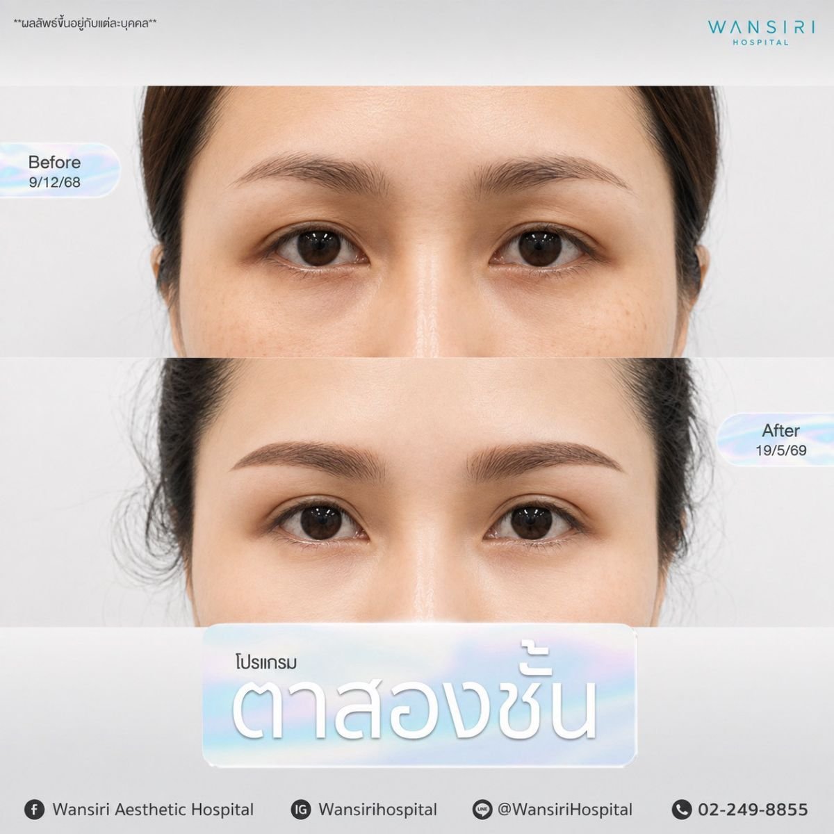 Vorher-nachher-Ergebnis der Blepharoplastik bei Wansiri Hospital, Lidkorrektur