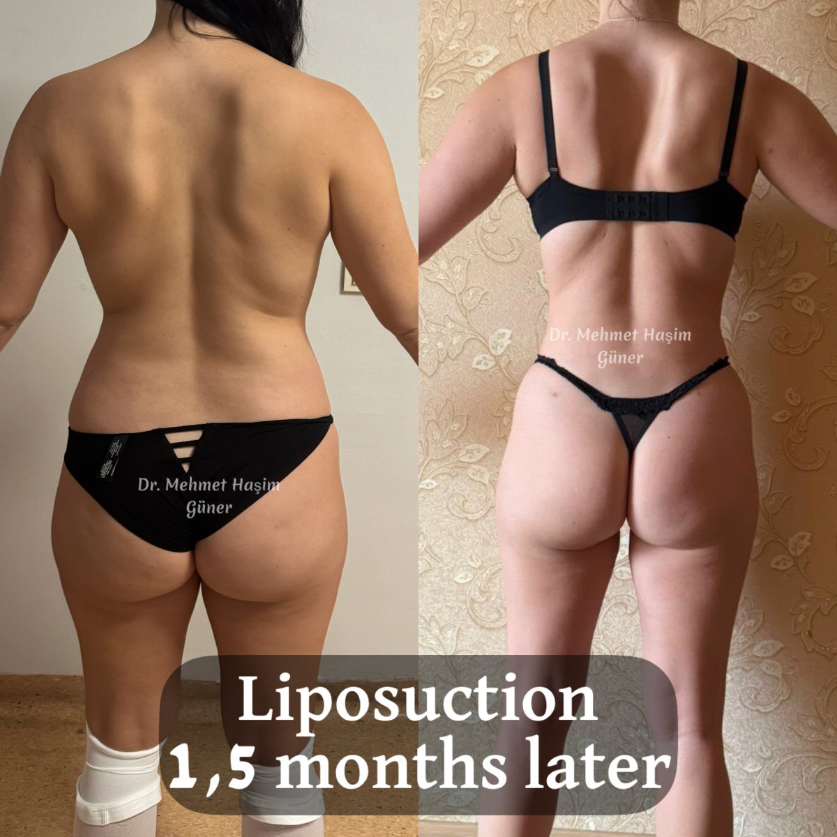 Liposuction before and after results at Dr. Mehmet Haşim Güner, 1.5 months body contour change