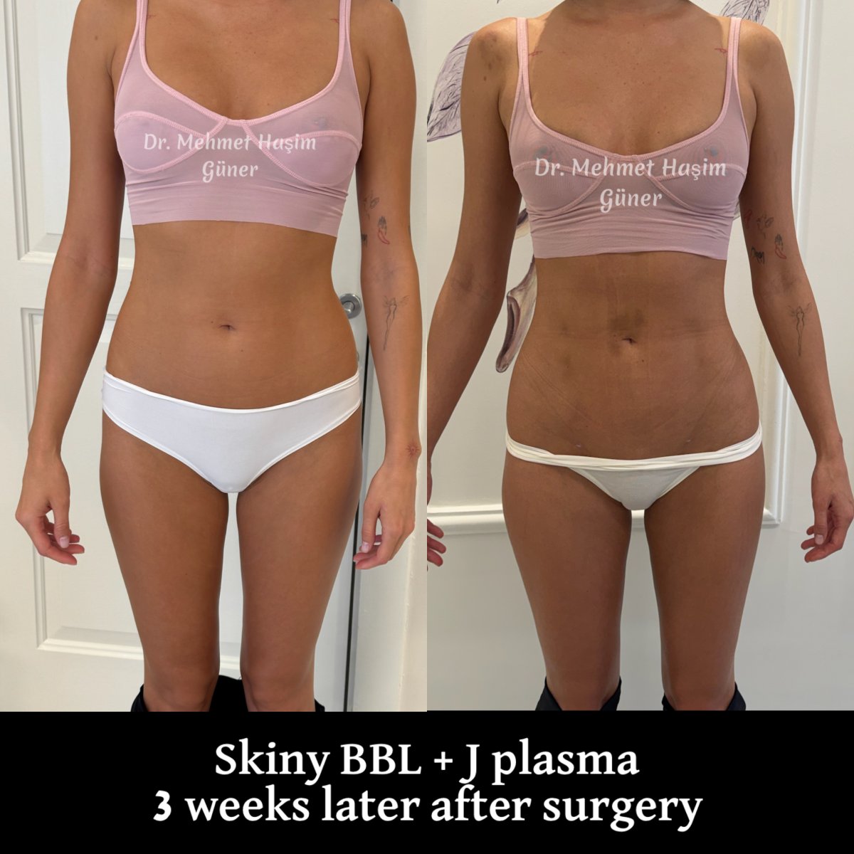 Before and after Skinny BBL with J Plasma results, 3 weeks post-surgery by Dr. Mehmet Haşim Güner