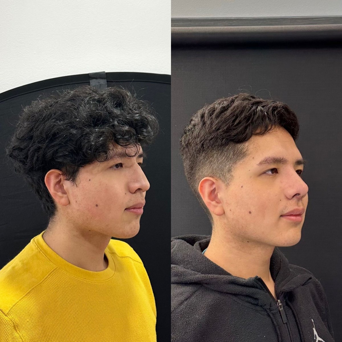 Antes y después de rinoplastia en Zafir Medical Center, perfil nasal mejorado