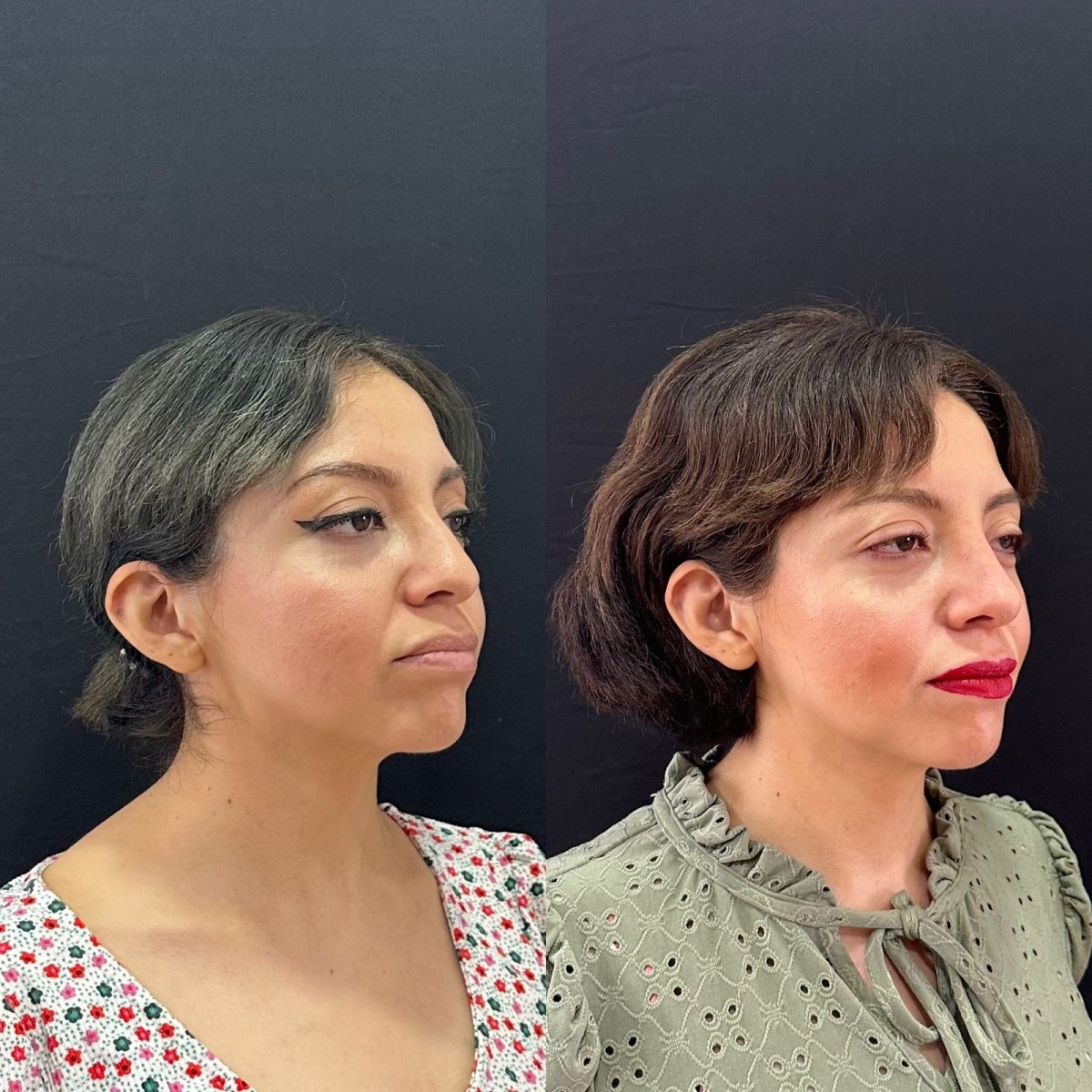 Before and after rhinoplasty results at Zafir Medical Center, improved nose contour visible