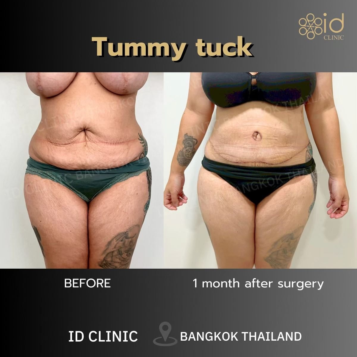 Before and after tummy tuck results at ID Clinic Bangkok, visible abdominal contour improvement