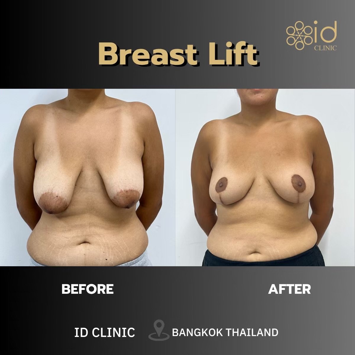نتائج شد الثدي قبل وبعد في ID Clinic Bangkok – تحسين شكل وتناسق الثدي