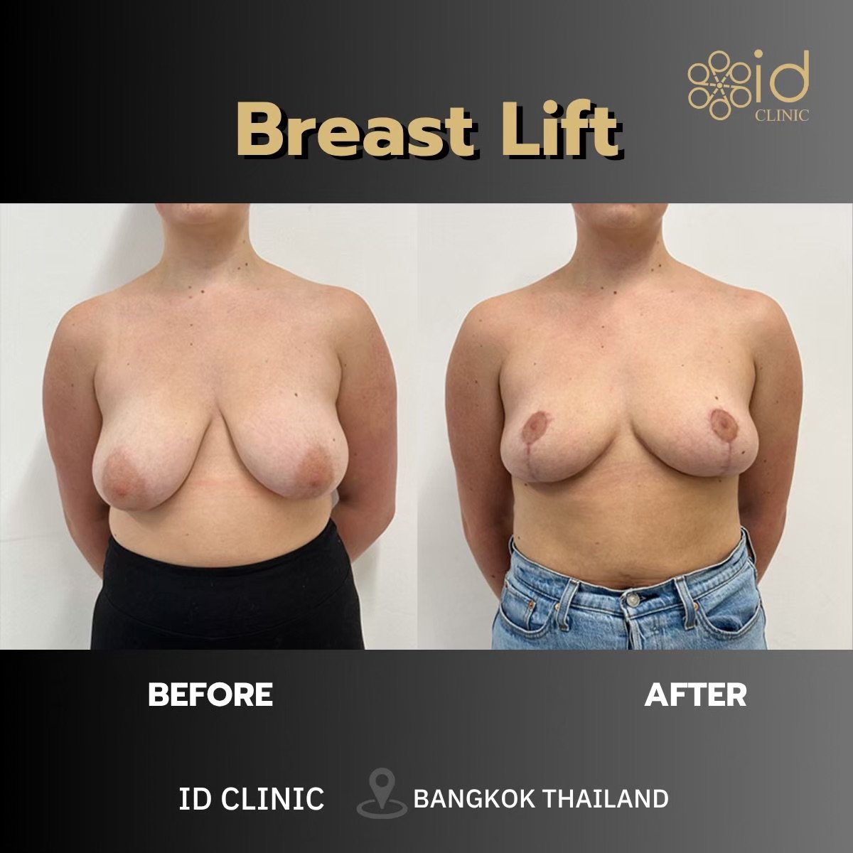 Результати до і після підтяжки грудей в ID Clinic Bangkok, покращений контур грудей