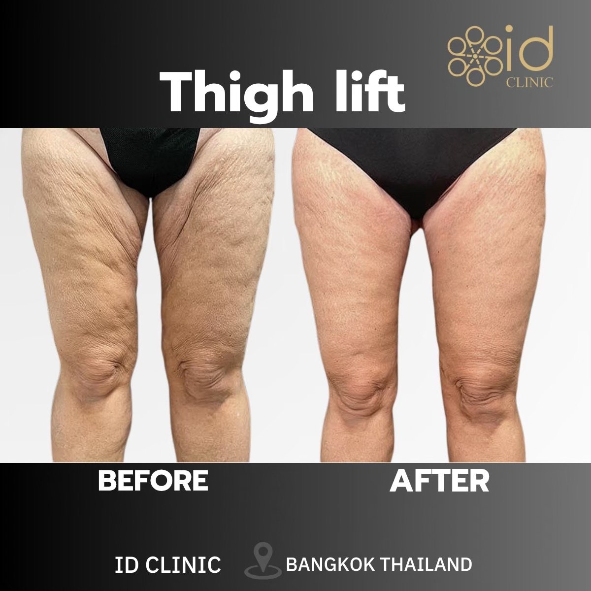 Результати підтяжки стегон до і після в ID Clinic Bangkok, покращений контур і пружність шкіри