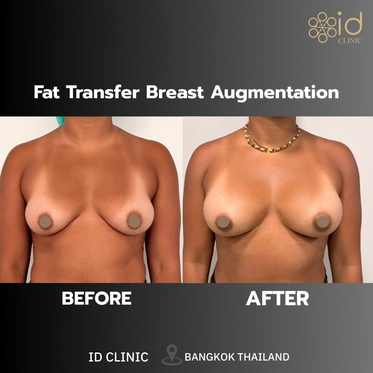 نتائج تكبير الثدي بحقن الدهون قبل وبعد في ID Clinic Bangkok