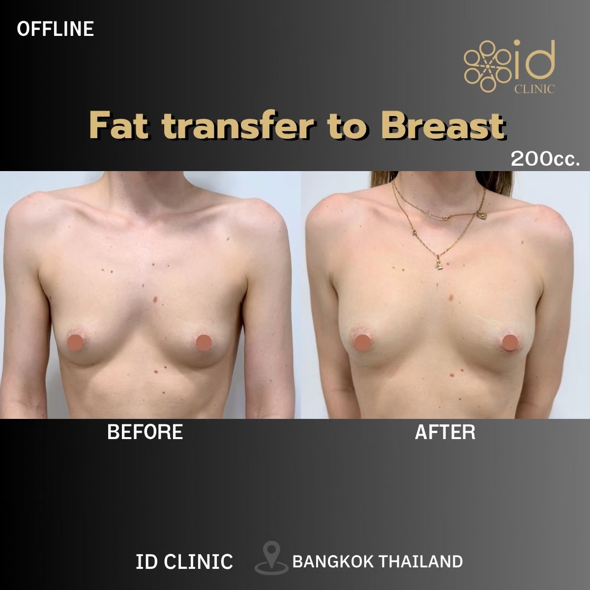Результат до і після ліпофілінгу грудей в ID Clinic Bangkok, природне збільшення грудей