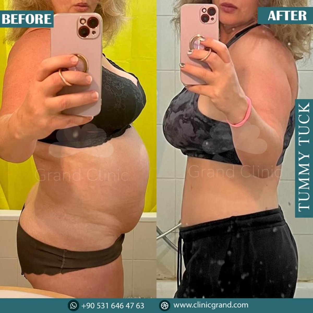 Résultats avant et après abdominoplastie à Grand Clinic – amélioration du ventre