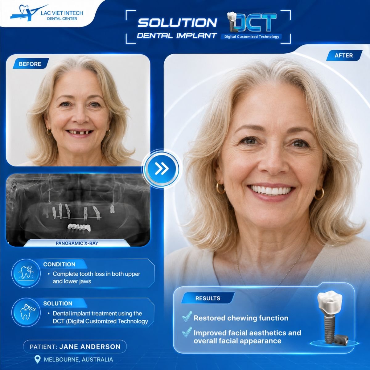 Résultats avant et après implant dentaire au Lac Viet Intech Dental Center, sourire restauré