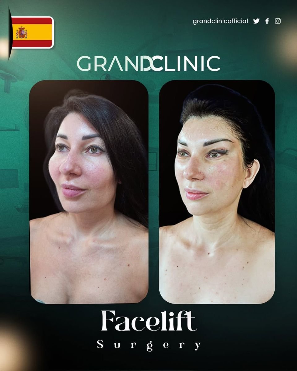 Resultados de lifting facial antes y después en Grand Clinic, rejuvenecimiento visible