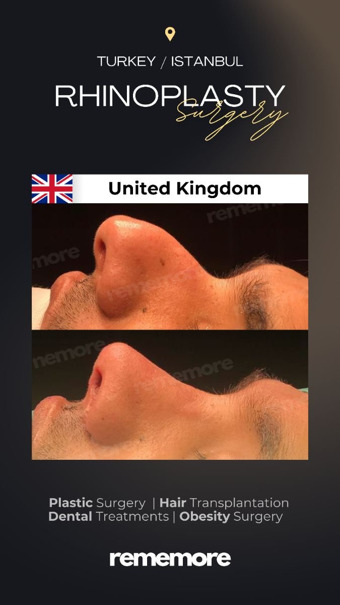 Before and after rhinoplasty results at Memorial Bahçelievler Hospital, nose reshaping
