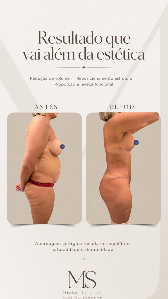 Resultados antes y después de mommy makeover en Dr. Michel Salameh - Cirugía Plástica