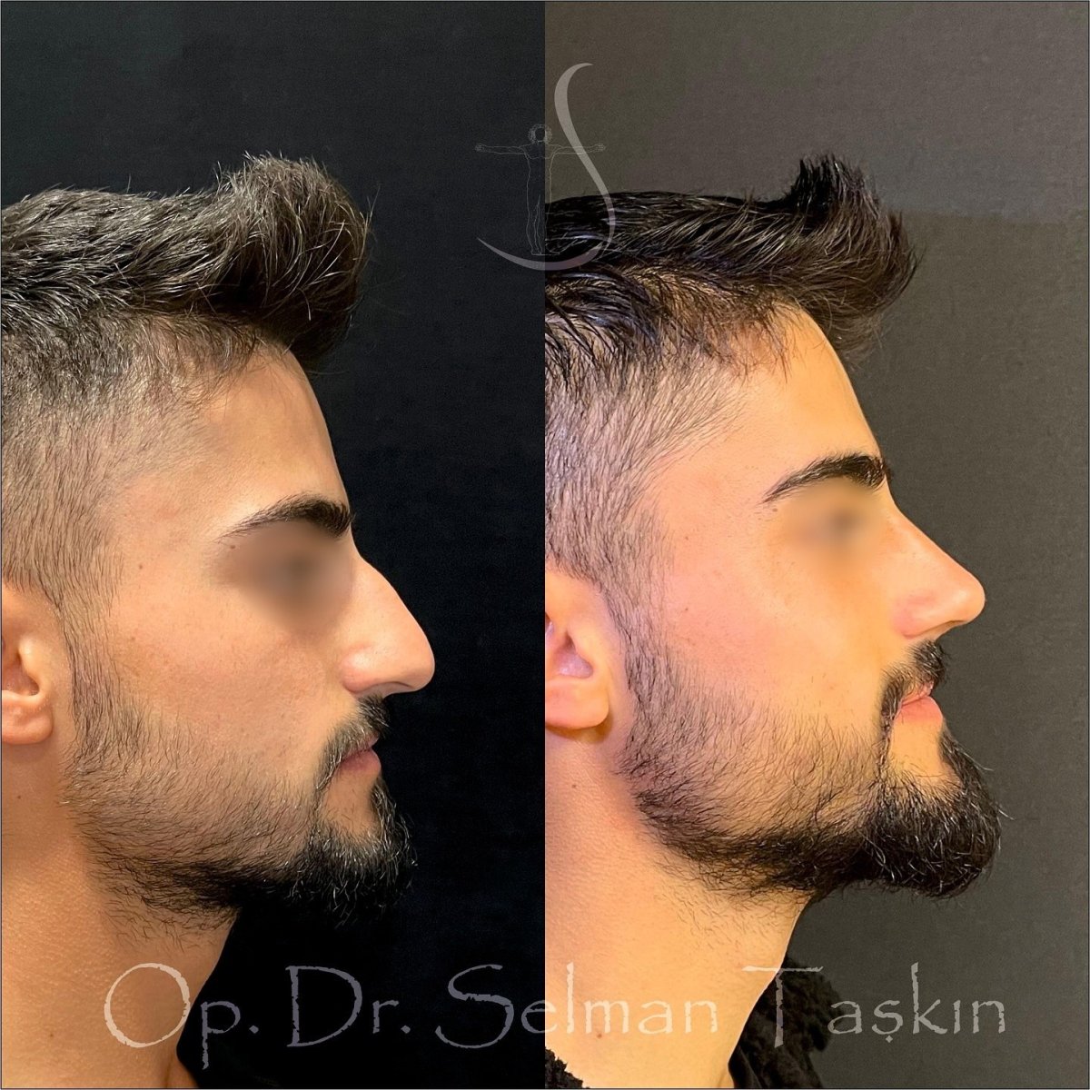 نتائج تجميل الأنف قبل وبعد في عيادة د. سلمان تاشكين، تحسين شكل الأنف
