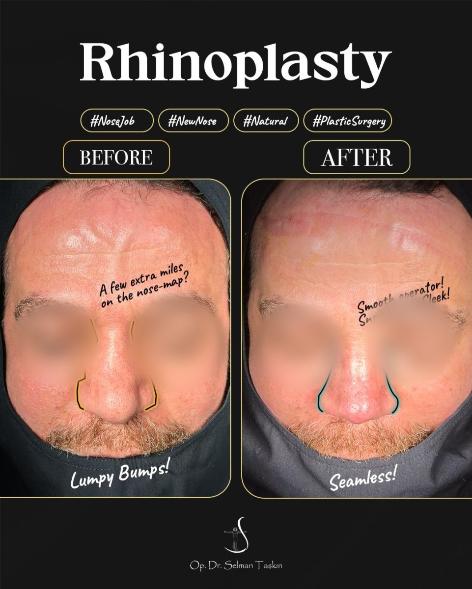 Resultados de rinoplastia antes y después en la clínica Dr. Selman Taskin, nariz más lisa