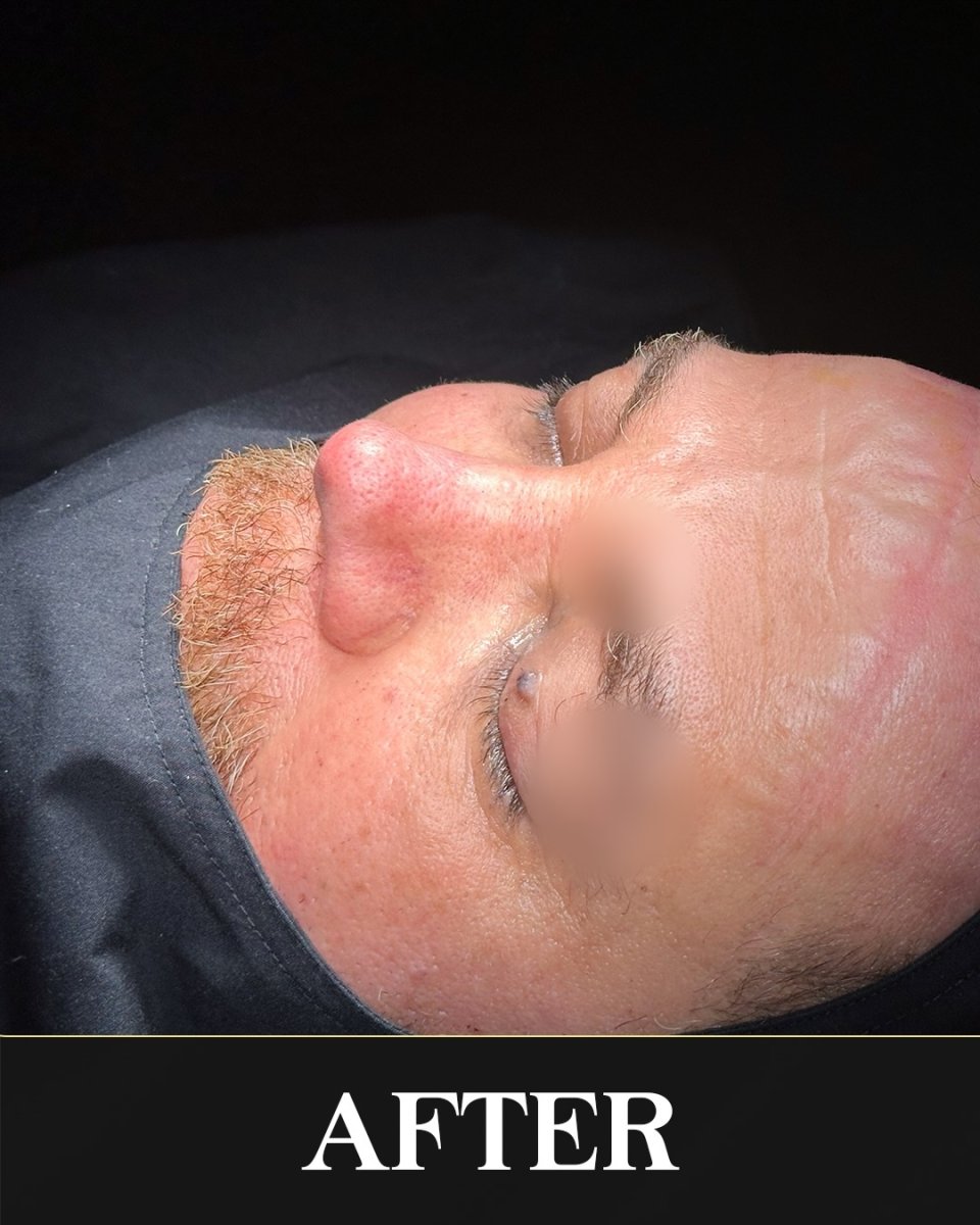 نتيجة عملية تجميل الأنف لرجل، شكل الأنف وتحسين مظهره واضحان